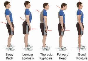 Posture Problems Chiropractic 300x210