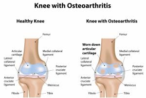 OA Knee 300x201