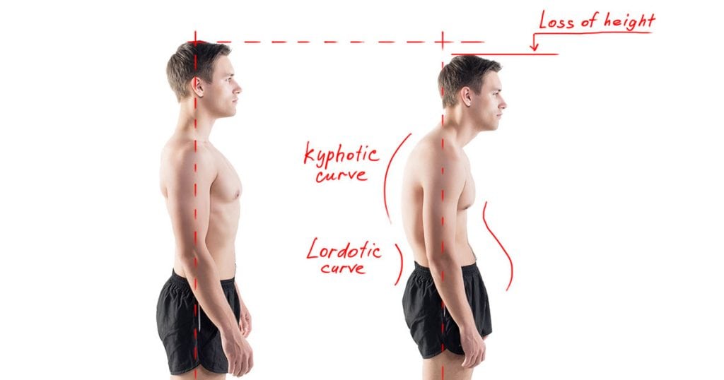 Kyphosis 1024x538