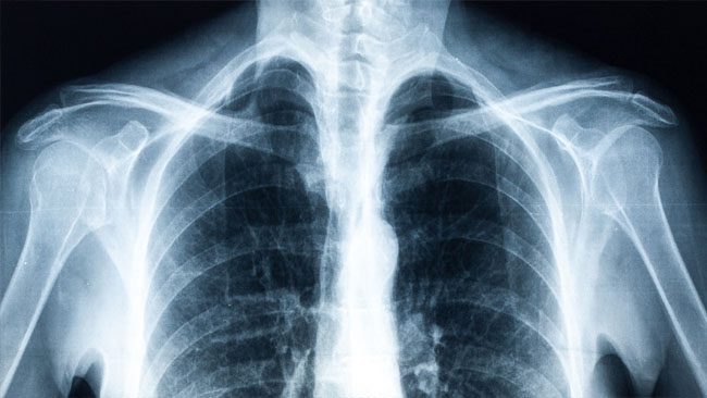 Xray